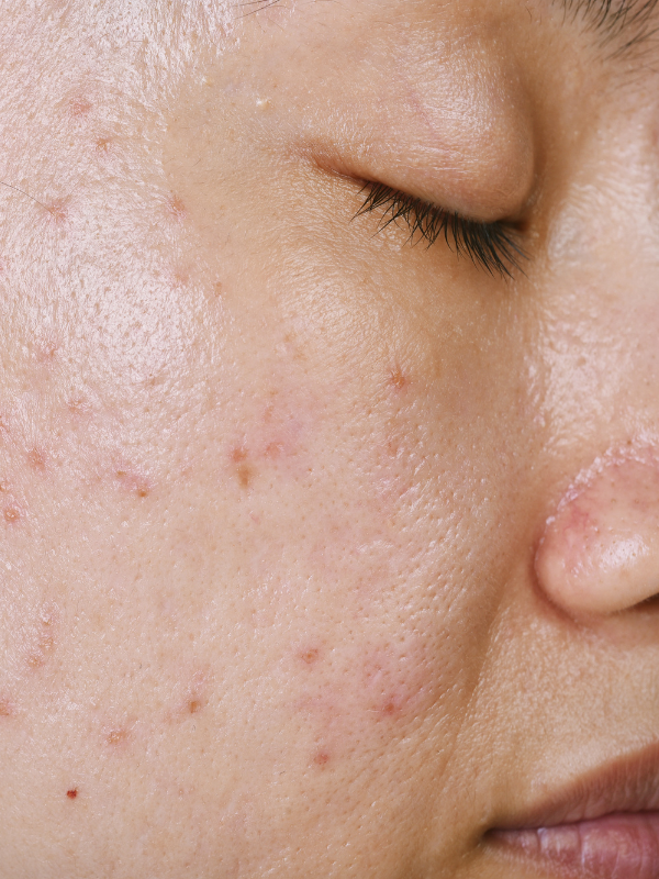 acne skin