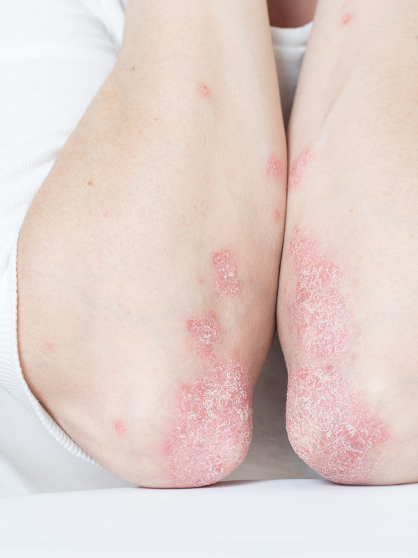 psoriasis on elbow