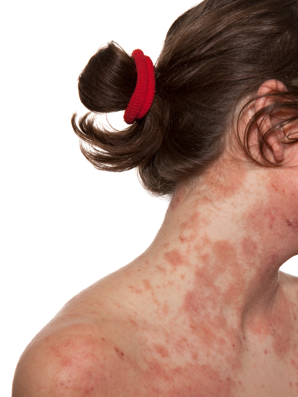person with atopic dermatitis